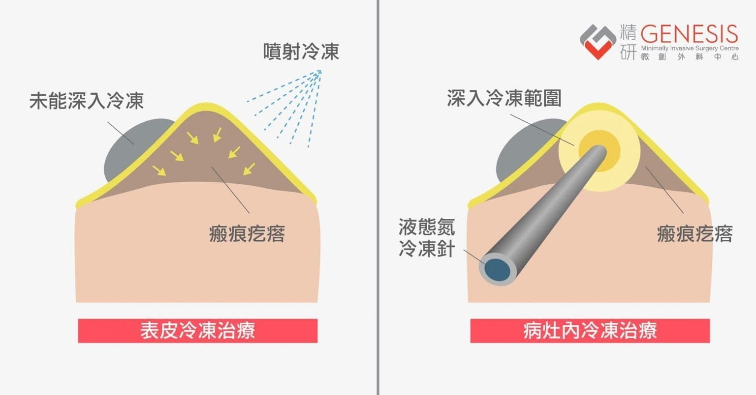 蟹足腫冷凍治療