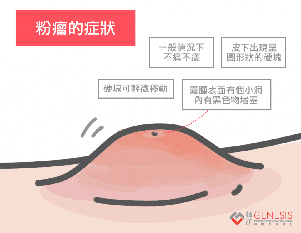 粉瘤手術