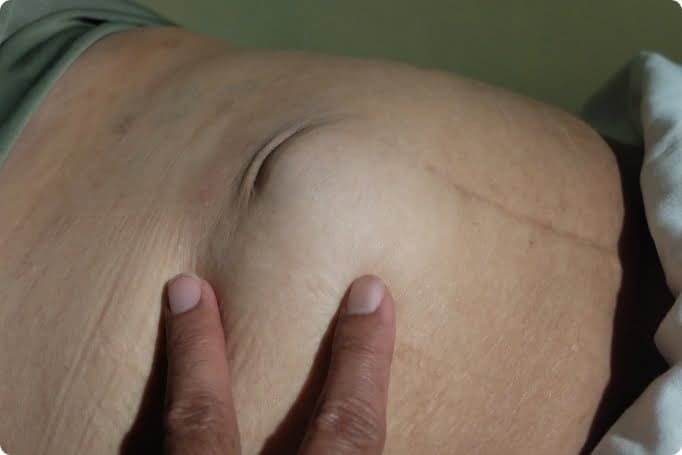小腸氣手術