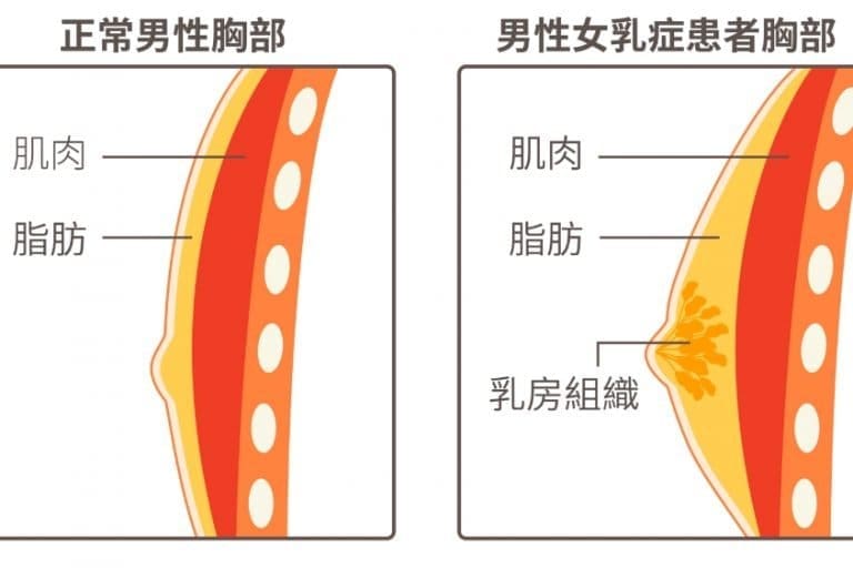 男性女乳症治療