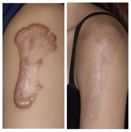 蟹足腫治療成功