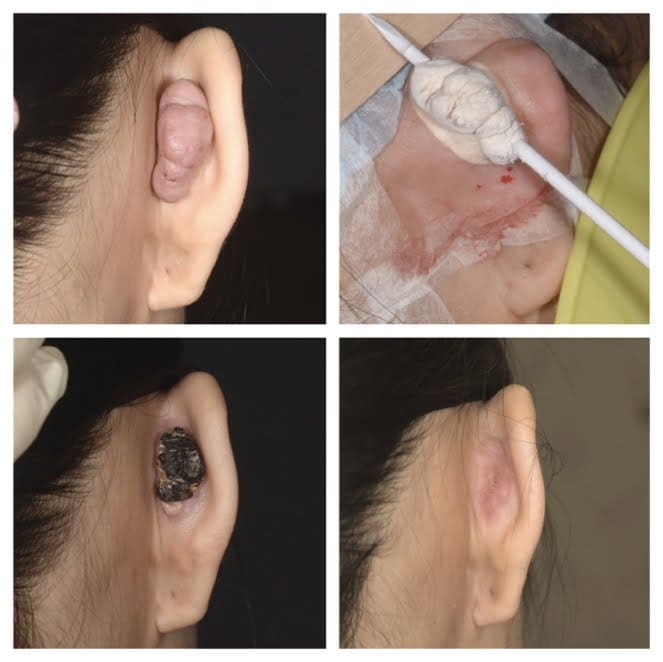 蟹足腫冷凍治療