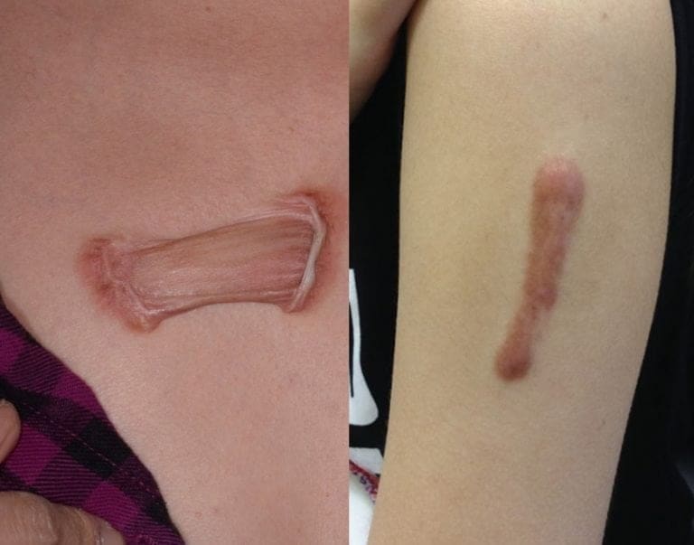 蟹足腫疤痕