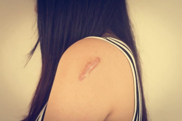 蟹足腫成因