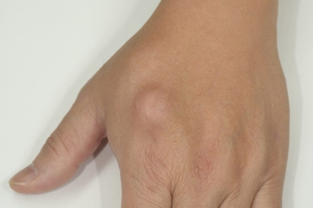 lipoma removal treatment