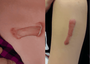 keloid removal