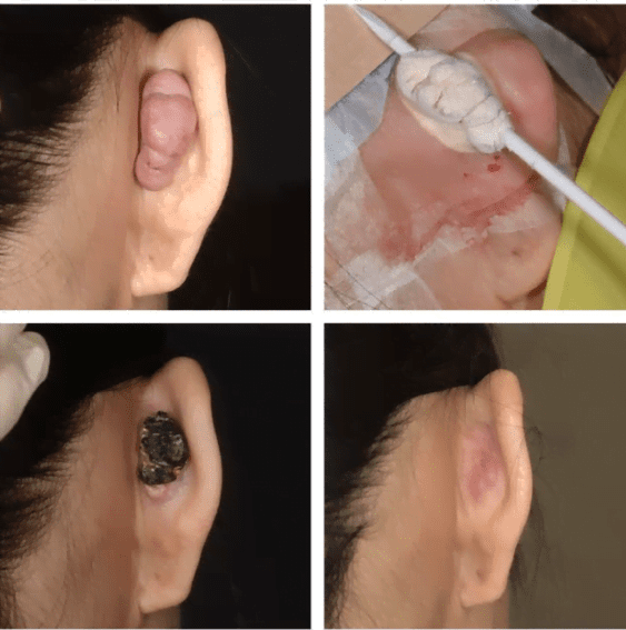 keloid removal