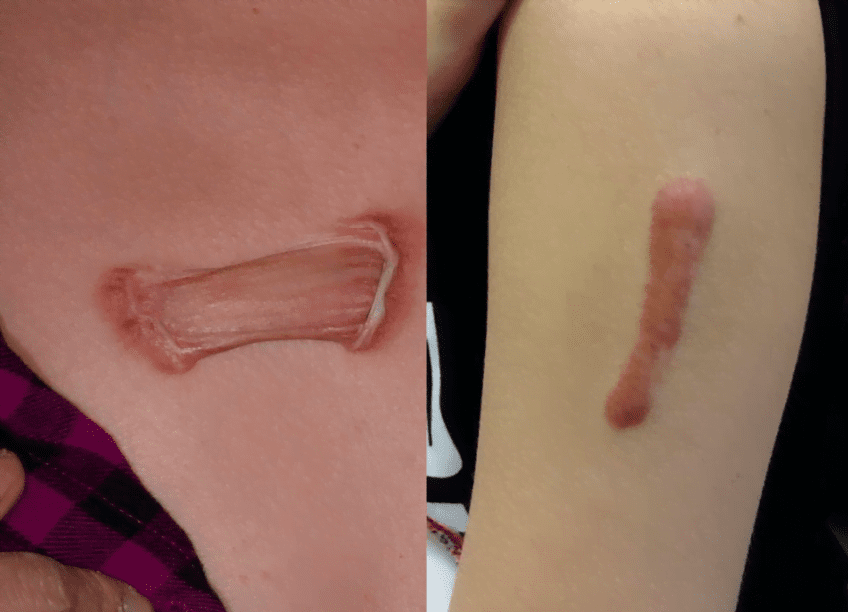 keloid removal
