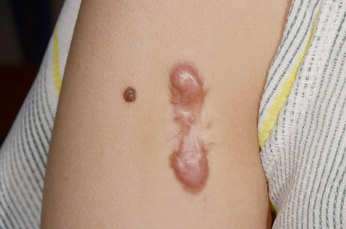 LA with Dexa, modified needle, single freeze, triam after thawin LA with Dexa, modified needle, single freeze, triam after thawin