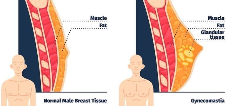 gynecomastia surgery treatment